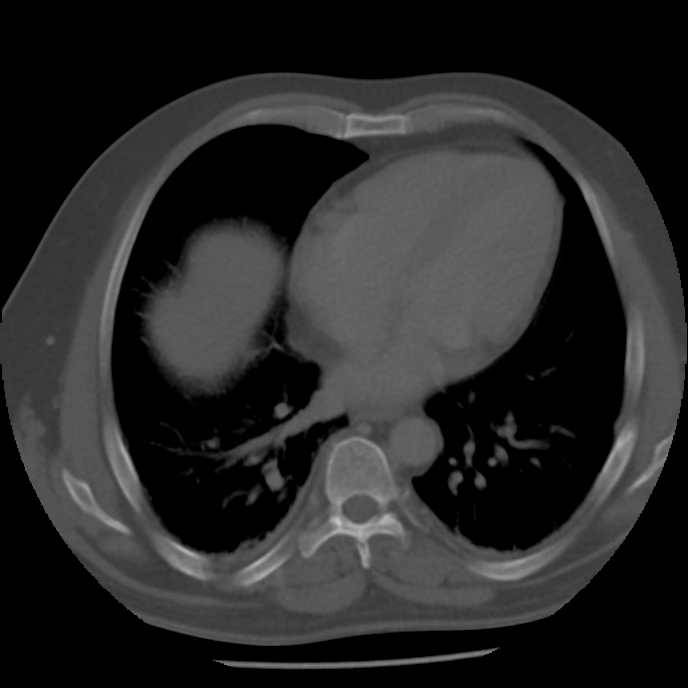 Appendicitis with perforation (Radiopaedia 35790-37342 Axial bone window 1).jpg