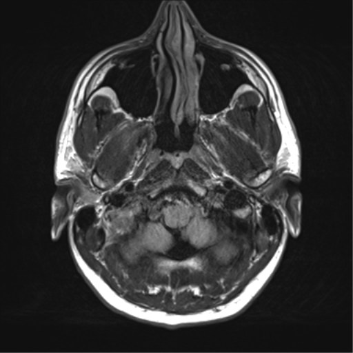 File:Arachnoid cyst - cerebellopontine angle (Radiopaedia 59689-67083 Axial FLAIR 4).png