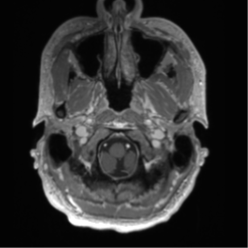 Arachnoid cyst with subdural hematoma (Radiopaedia 85892-101743 Axial T1 C+ 11).png