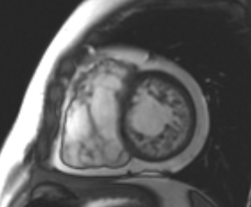 File:Arrhythmogenic right ventricular cardiomyopathy (Radiopaedia 69431-79307 Short axis cine 100).jpg