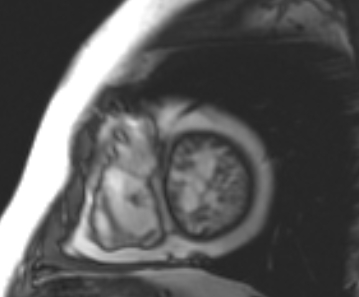 File:Arrhythmogenic right ventricular cardiomyopathy (Radiopaedia 69431-79307 Short axis cine 56).jpg