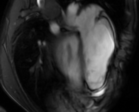 Arrhythmogenic right ventricular cardiomyopathy (Radiopaedia 69564-79464 4ch cine 120).jpg