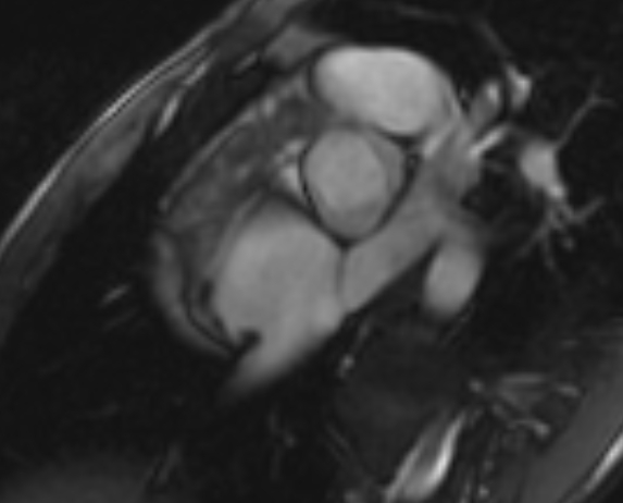 Arrhythmogenic right ventricular cardiomyopathy (Radiopaedia 69564-79464 short axis cine 283).jpg