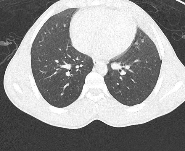 Arrow injury to the chest (Radiopaedia 75223-86321 Axial lung window 55).jpg