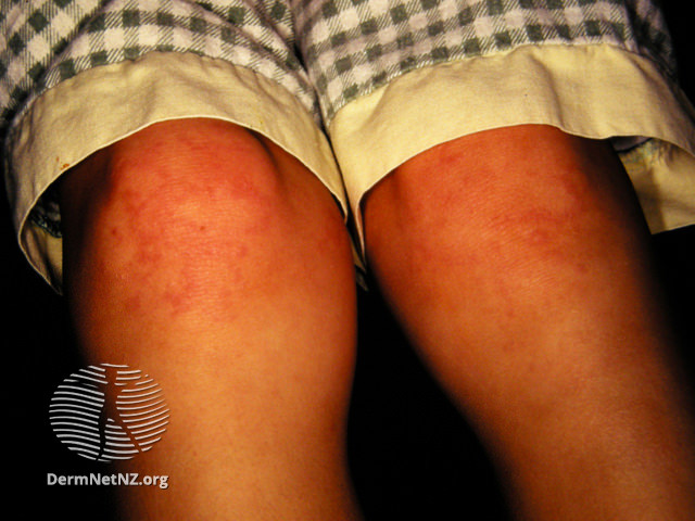 File:Arthritis (DermNet NZ juvenile-arthritis-1).jpg