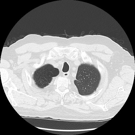Asbestos-related pleural disease (Radiopaedia 74366-85250 Axial lung window 17).jpg