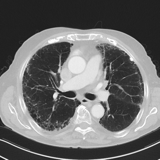 File:Asbestosis (Radiopaedia 56192-62864 Axial lung window 30).png