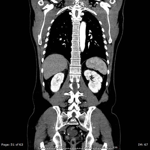 Ascending aortic aneurysm (Radiopaedia 50086-55404 B 51).jpg