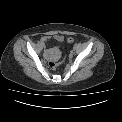 Ascending retrocecal appendicitis with liver abscesses (Radiopaedia 60066-67615 Axial non-contrast 72).jpg