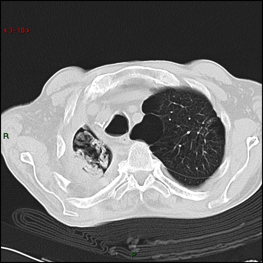 File:Aspergilloma (Radiopaedia 14842-14787 Axial lung window 10).jpg