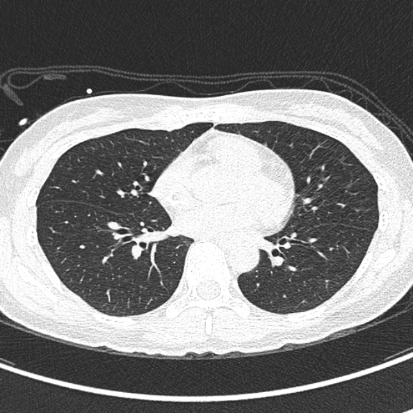 Aspergilloma (Radiopaedia 26223-26347 Axial lung window 44).jpg