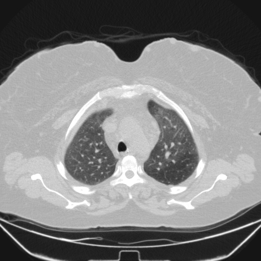 Aspergilloma (Radiopaedia 39611-41932 Axial lung window 28).jpg