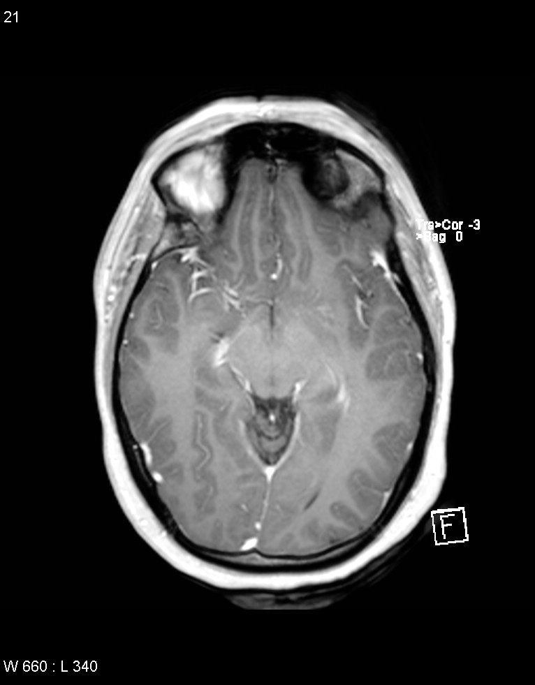 Astroblastoma (Radiopaedia 39792-42218 Axial T1 C+ 20).jpg