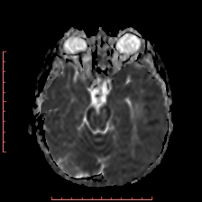 Astroblastoma (Radiopaedia 74287-85162 Axial ADC 20).jpg