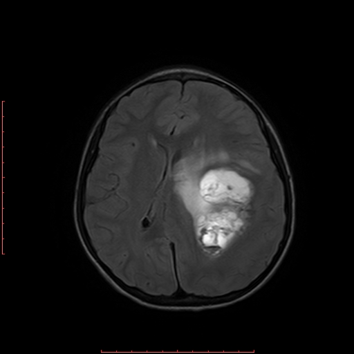 File:Astroblastoma (Radiopaedia 74287-85162 Axial FLAIR 13).jpg