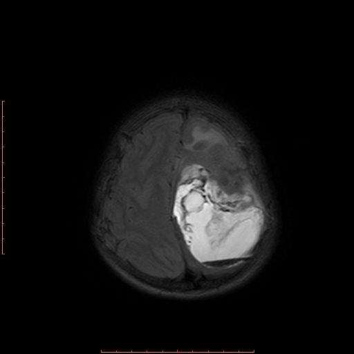 File:Astroblastoma (Radiopaedia 74287-85162 Axial FLAIR 19).jpg