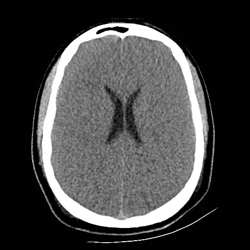 File:Atlanto-occipital dislocation (Radiopaedia 44648-48412 Axial non-contrast 35).jpg