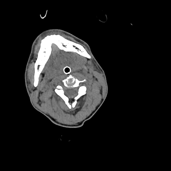 File:Atlanto-occipital dissociation (Traynelis type 1), C2 teardrop fracture, C6-7 facet joint dislocation (Radiopaedia 87655-104061 Axial non-contrast 29).jpg