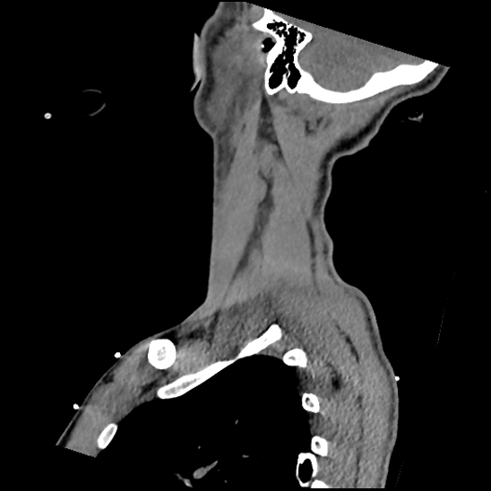 Atlanto-occipital dissociation (Traynelis type 1), C2 teardrop fracture, C6-7 facet joint dislocation (Radiopaedia 87655-104061 D 70).jpg