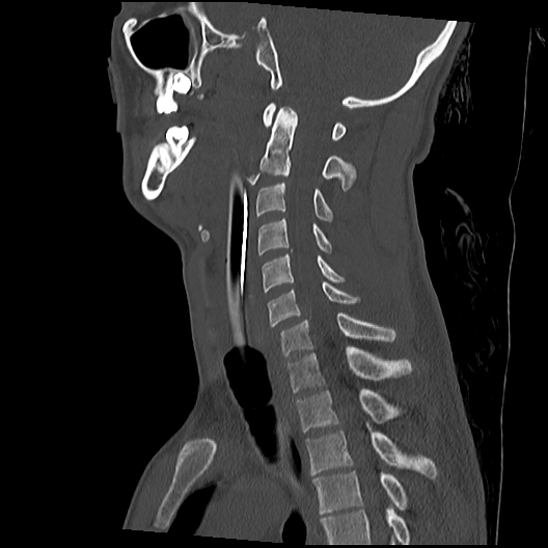 File:Atlanto-occipital dissociation (Traynelis type 1), C2 teardrop fracture, C6-7 facet joint dislocation (Radiopaedia 87655-104061 Sagittal bone window 37).jpg