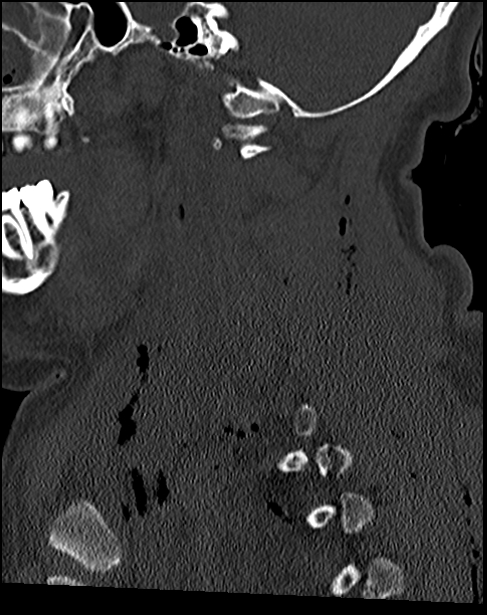 Atlanto-occipital dissociation - Traynelis type 1 (Radiopaedia 87570-103948 Sagittal bone window 33).jpg