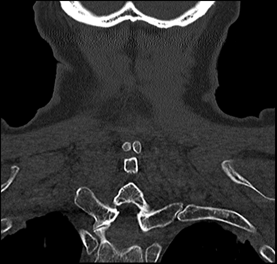 Atlas (type 3b subtype 1) and axis (Anderson and D'Alonzo type 3, Roy-Camille type 2) fractures (Radiopaedia 88043-104607 Coronal bone window 54).jpg