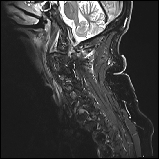 File:Atlas (type 3b subtype 1) and axis (Anderson and D'Alonzo type 3, Roy-Camille type 2) fractures (Radiopaedia 88043-104610 Sagittal STIR 1).jpg