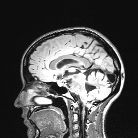 Atretic encephalocoele with inferior vermis hypoplasia (Radiopaedia 30443-31108 Axial 157).jpg
