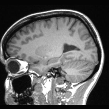 Atretic encephalocoele with inferior vermis hypoplasia (Radiopaedia 30443-31108 Sagittal T1 91).jpg