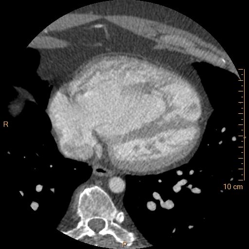 File:Atrial septal defect (upper sinus venosus type) with partial anomalous pulmonary venous return into superior vena cava (Radiopaedia 73228-83961 A 203).jpg