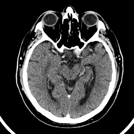 Atypical meningioma (WHO grade II) with brain invasion (Radiopaedia 57767-64728 Axial C+ 34).png