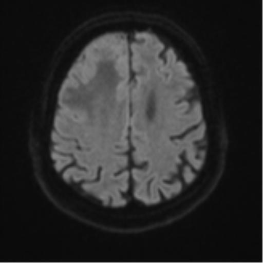 Atypical meningioma (WHO grade II) with brain invasion (Radiopaedia 57767-64729 Axial DWI 52).png