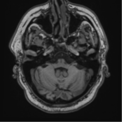File:Atypical meningioma (WHO grade II) with brain invasion (Radiopaedia 57767-64729 Axial T1 10).png