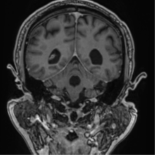 Atypical meningioma (WHO grade II) with brain invasion (Radiopaedia 57767-64729 Coronal T1 C+ 57).png
