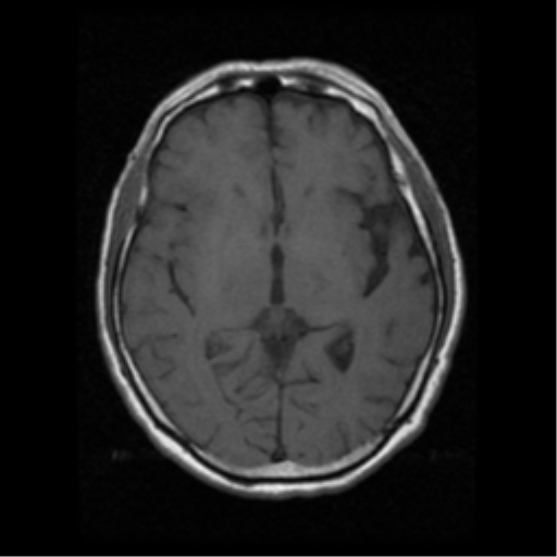 File:Atypical meningioma (WHO grade II) with osseous invasion (Radiopaedia 53654-59716 Axial T1 11).png