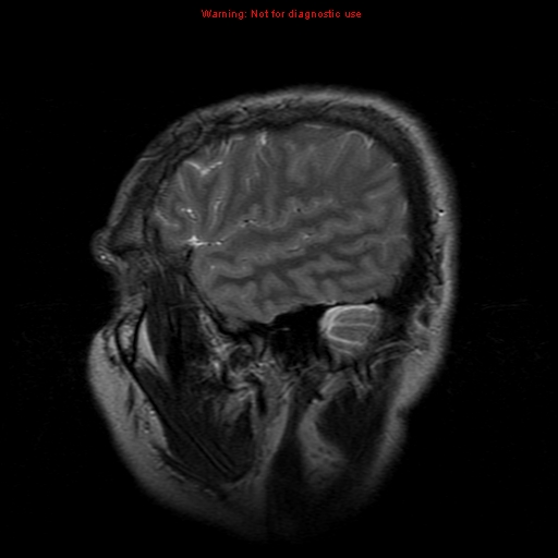 File:Atypical meningioma - grade II (Radiopaedia 13303-13305 Sagittal T2 4).jpg