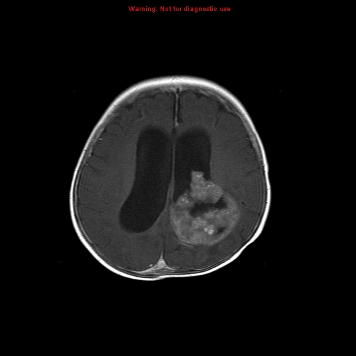 File:Atypical teratoid rhabdoid tumor (Radiopaedia 10712-11183 Axial T1 C+ 6).jpg