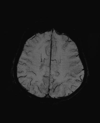 Autoimmune limbic encephalitis (Radiopaedia 30363-31005 SWI - mIP 52).jpg