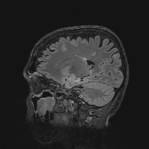 File:Autoimmune limbic encephalitis (Radiopaedia 30363-31005 Sagittal FLAIR 99).jpg