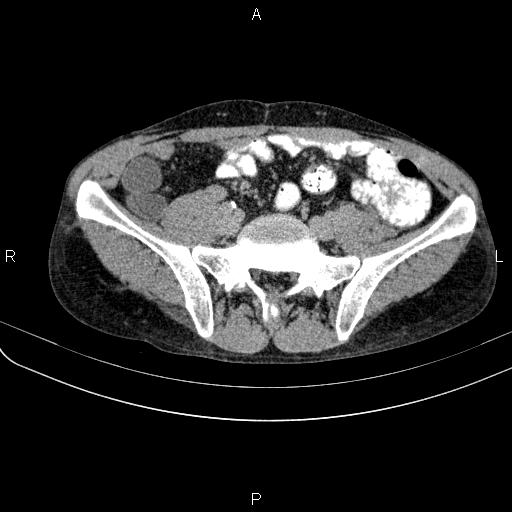 Autoimmune pancreatitis (Radiopaedia 84925-100431 Axial C+ delayed 64).jpg