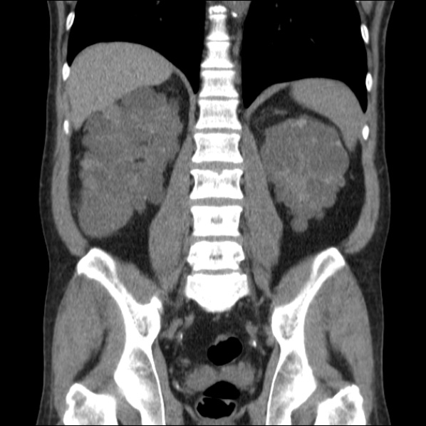 Autosomal dominant polycystic kidney disease (Radiopaedia 36539-38101 C 47).jpg