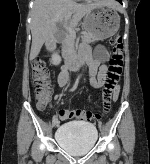 Autosomal dominant polycystic kidney disease (Radiopaedia 38189-40194 Coronal C+ delayed 33).jpg