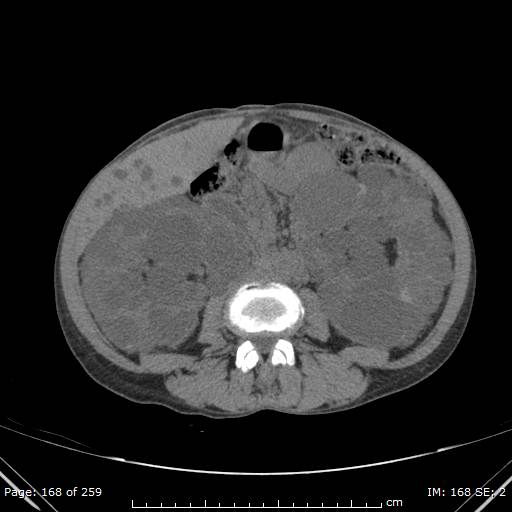 File:Autosomal dominant polycystic kidney disease (Radiopaedia 44122-47684 Axial 26).jpg