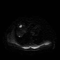 Autosomal dominant polycystic kidney disease (Radiopaedia 50259-55611 Axial DWI 2).jpg