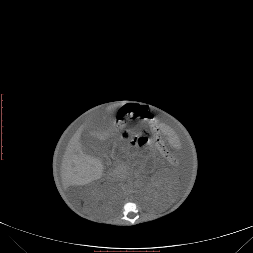 Autosomal recessive polycystic kidney disease associated with Caroli disease (Radiopaedia 61932-69984 Axial non-contrast 198).jpg