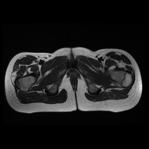 File:Avascular necrosis of the hip (Radiopaedia 29563-30067 Axial T2 15).jpg