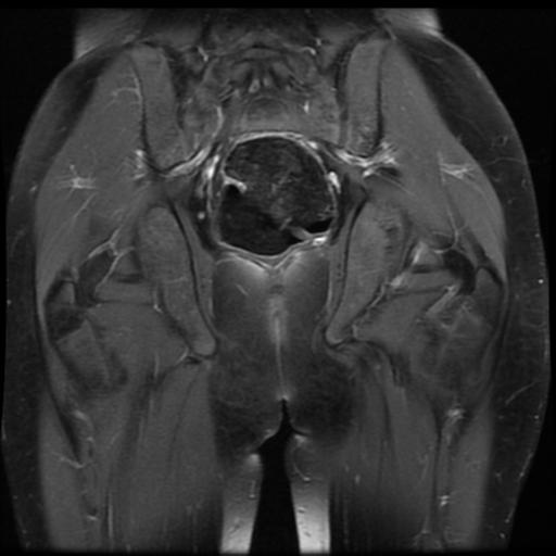 File:Avascular necrosis of the hip (Radiopaedia 29563-30067 I 13).jpg