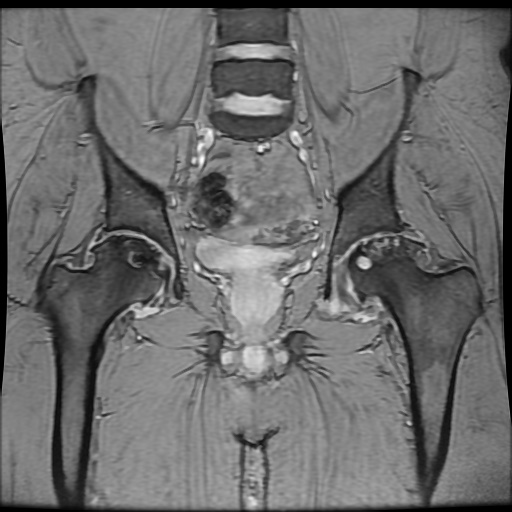Avascular necrosis of the hip (Radiopaedia 61503-69465 F 50).jpg