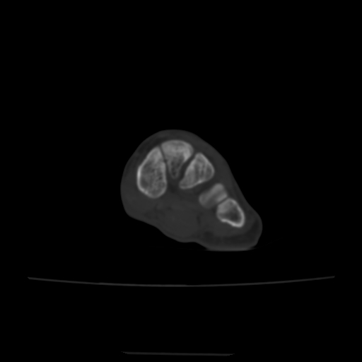 Avulsion fracture of the dorsal cuboid bone (Radiopaedia 51586-57377 Axial bone window 110).jpg