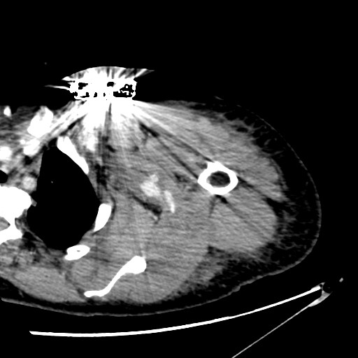 File:Axillary arterial pseudoaneurysm (Radiopaedia 24925-25195 A 8).jpg